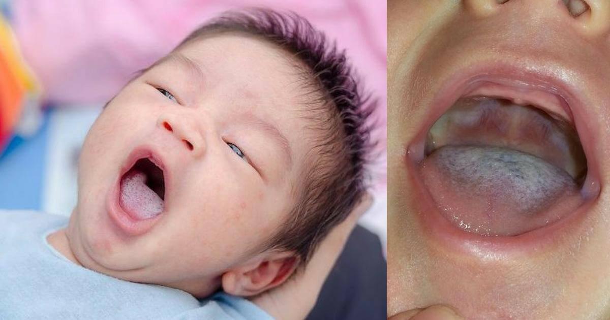 Cara Membersihkan Lidah Bayi yang Putih: Panduan Lengkap untuk Orang Tua
